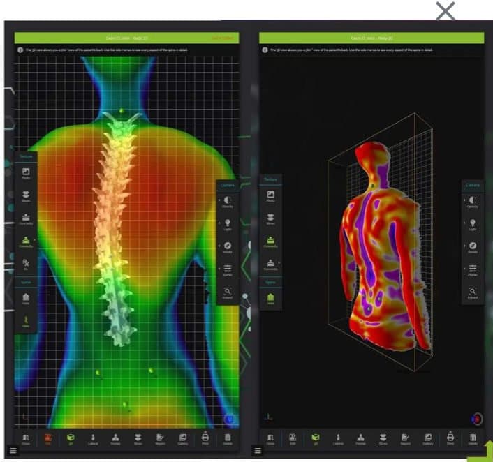 Cartographie des courbures du rachis restituée par le Spine 3D